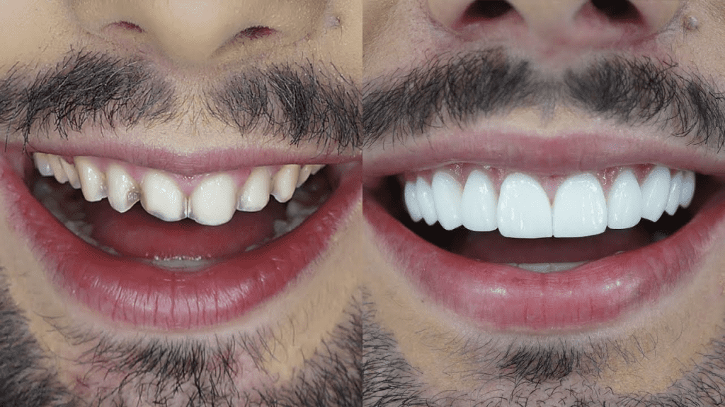 Antes e depois de lentes de contato dental (facetas)