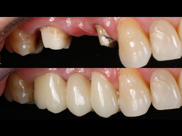 Antes e depois de prótese fixa de 3 elementos