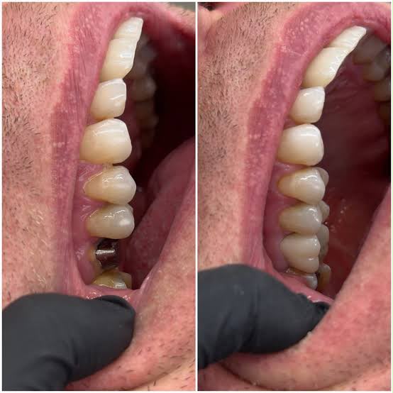 Antes e depois de prótese fixa com pino e coroa