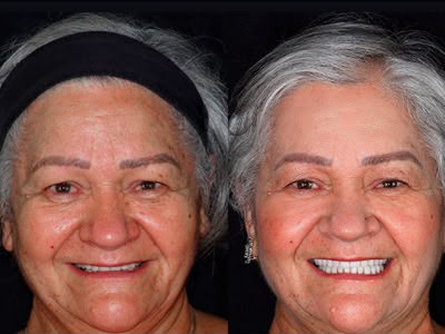 Antes e depois de prótese total em paciente
