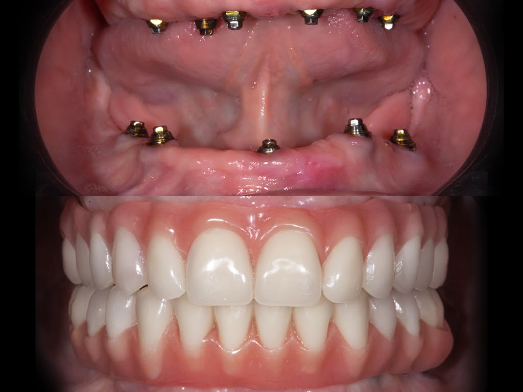Antes e depois de protocolo, prótese total sobre implantes