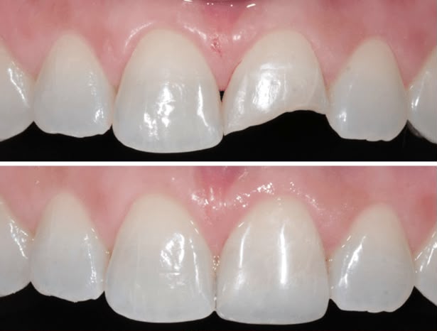 Antes e depois de restauração dentária em dente anterior fraturado