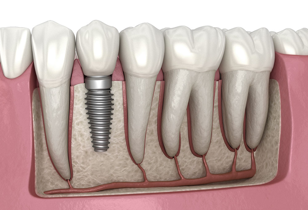 Ilustração em corte de implante dentário de titânio ao lado dos dentes naturais